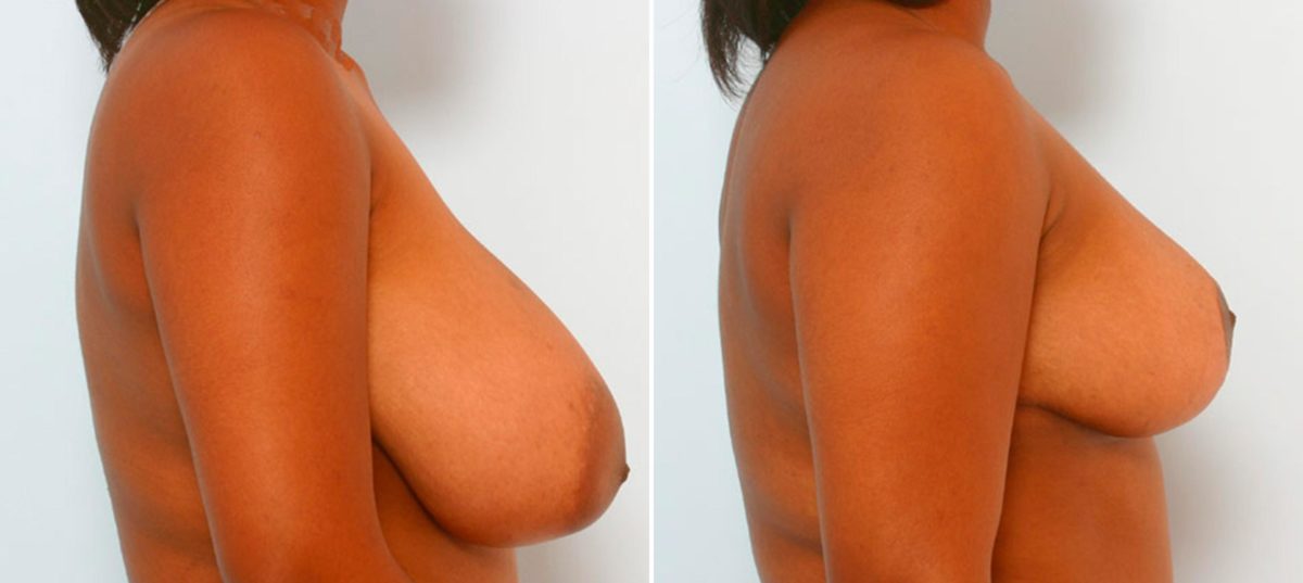 Breast Reduction Before and After Photos in Houston, TX, Patient 27545