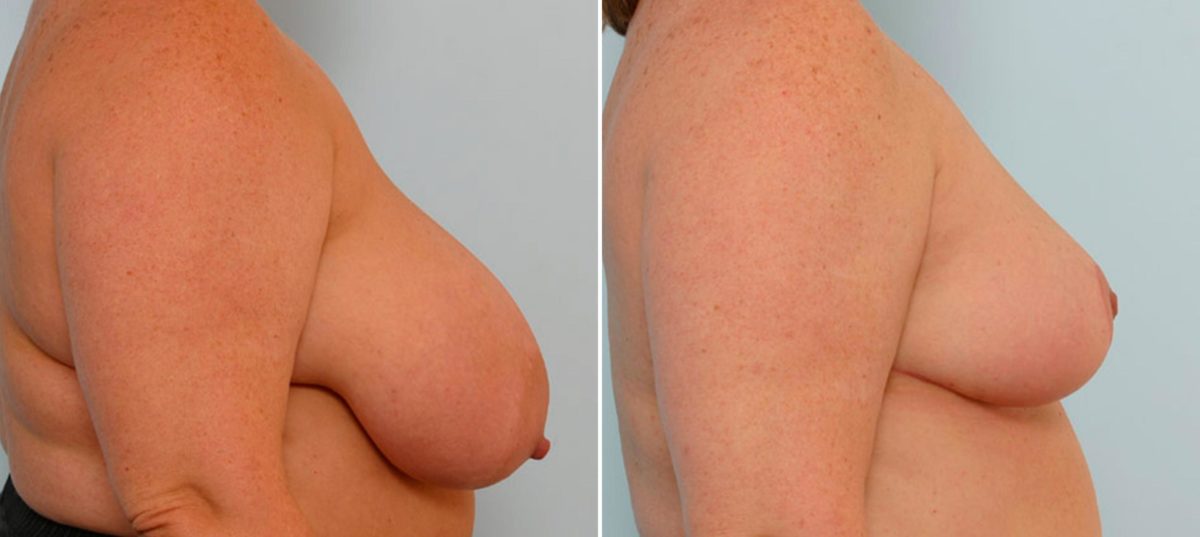 Breast Reduction Before and After Photos in Houston, TX, Patient 27594