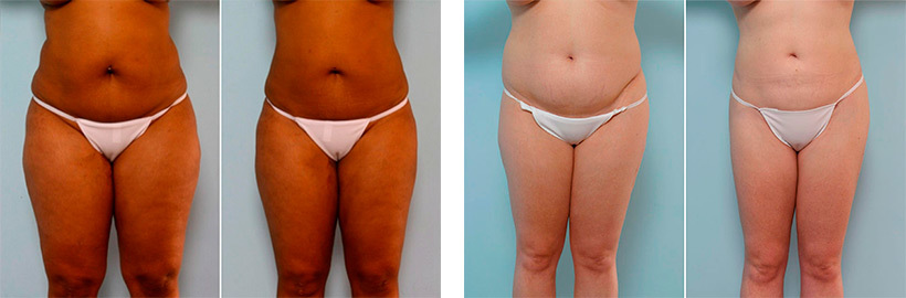 Lipo pre and post