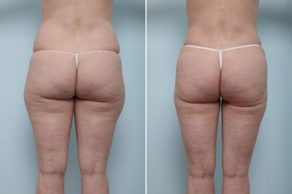Abdominoplasty Before and After Photos in Houston, TX, Patient 59222