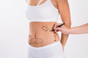 What Happens After Liposuction?