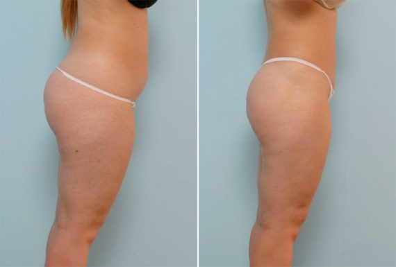 Liposuction Before and After Photos in Houston, TX, Patient 29052