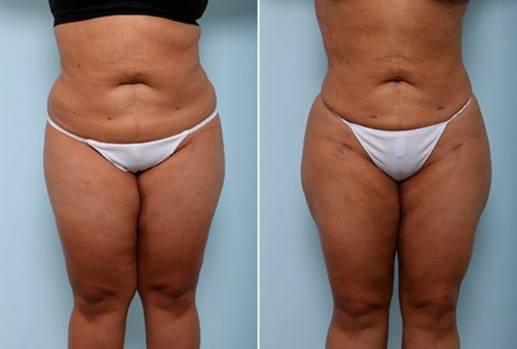 Butt Augmentation Before and After Photos in Houston, TX, Patient 27935