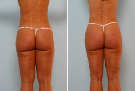 BBL or Butt Implants: What’s the Difference?, Before and After Photos Butt Augmentation Before and After Photos in Houston, TX, Patient 27901