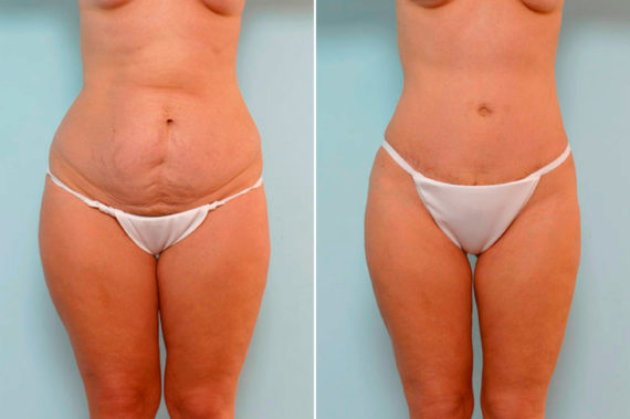 Abdominoplasty Before and After Photos in Houston, TX, Patient 24624