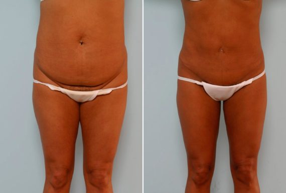 5 Things No One Tells You About a Tummy Tuck, Before and After Photos Abdominoplasty Before and After Photos in Houston, TX, Patient 24410