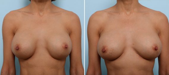 What to Do If Your Implants Are Too Large, Before and After Photos Breast Implant Exchange Before and After Photos in Houston, TX, Patient 27425