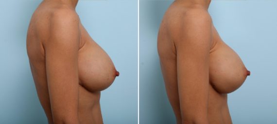 What to Do If Your Implants Are Too Large, Before and After Photos Breast Implant Exchange Before and After Photos in Houston, TX, Patient 27425