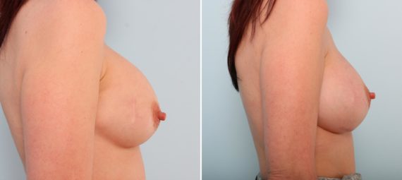 Breast Implant Exchange Before and After Photos in Houston, TX, Patient 27404