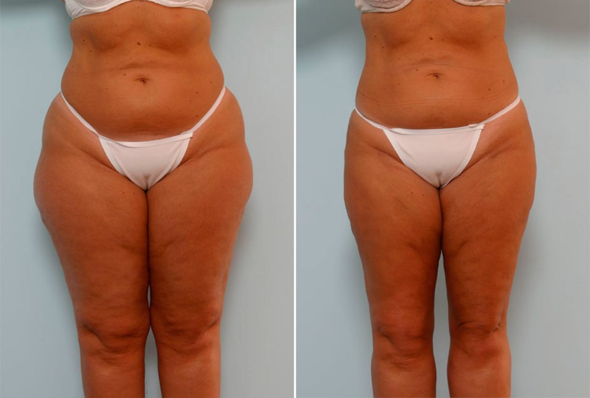 Liposuction Before and After Photos in Houston, TX, Patient 29045