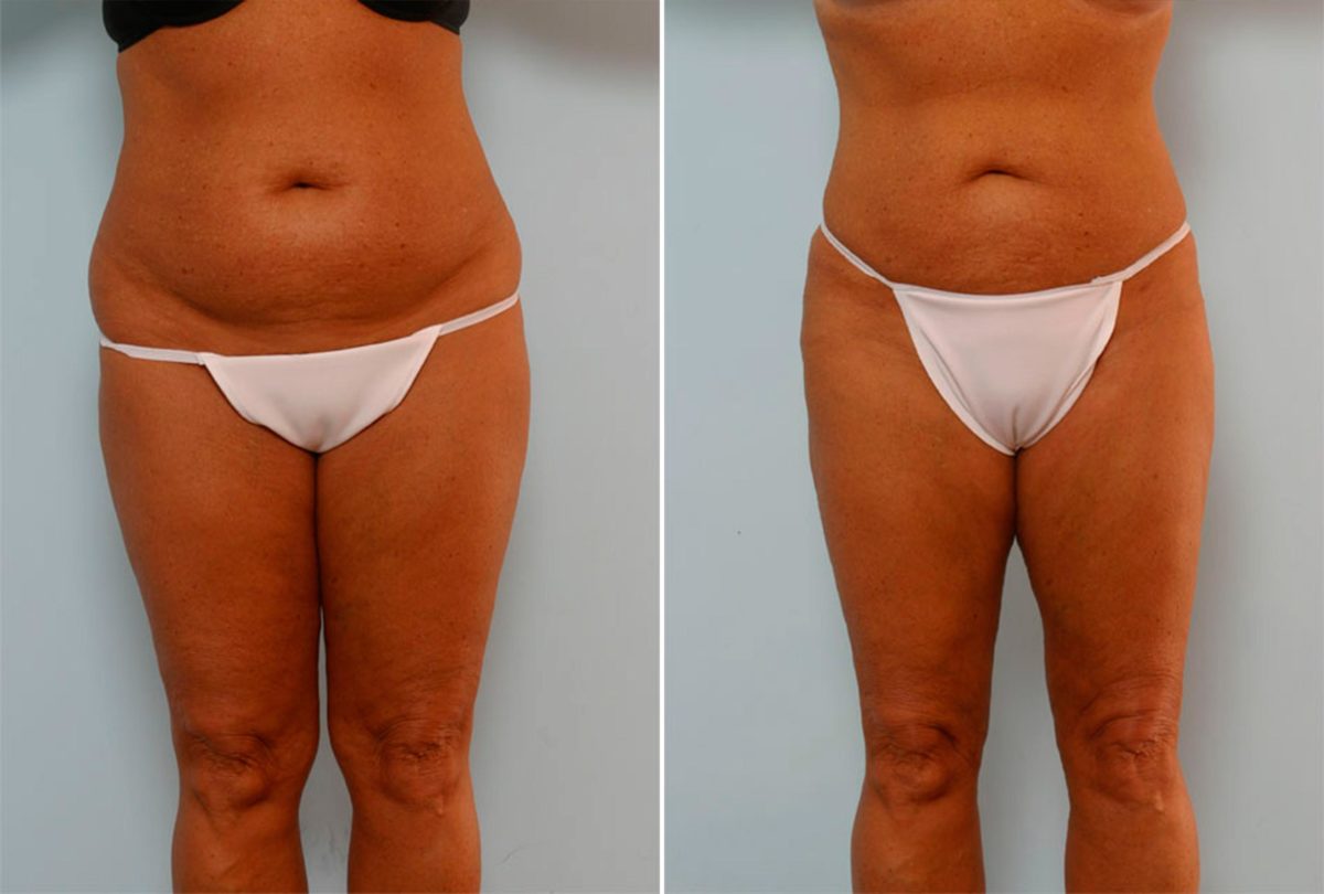Liposuction Before and After Photos in Houston, TX, Patient 28979