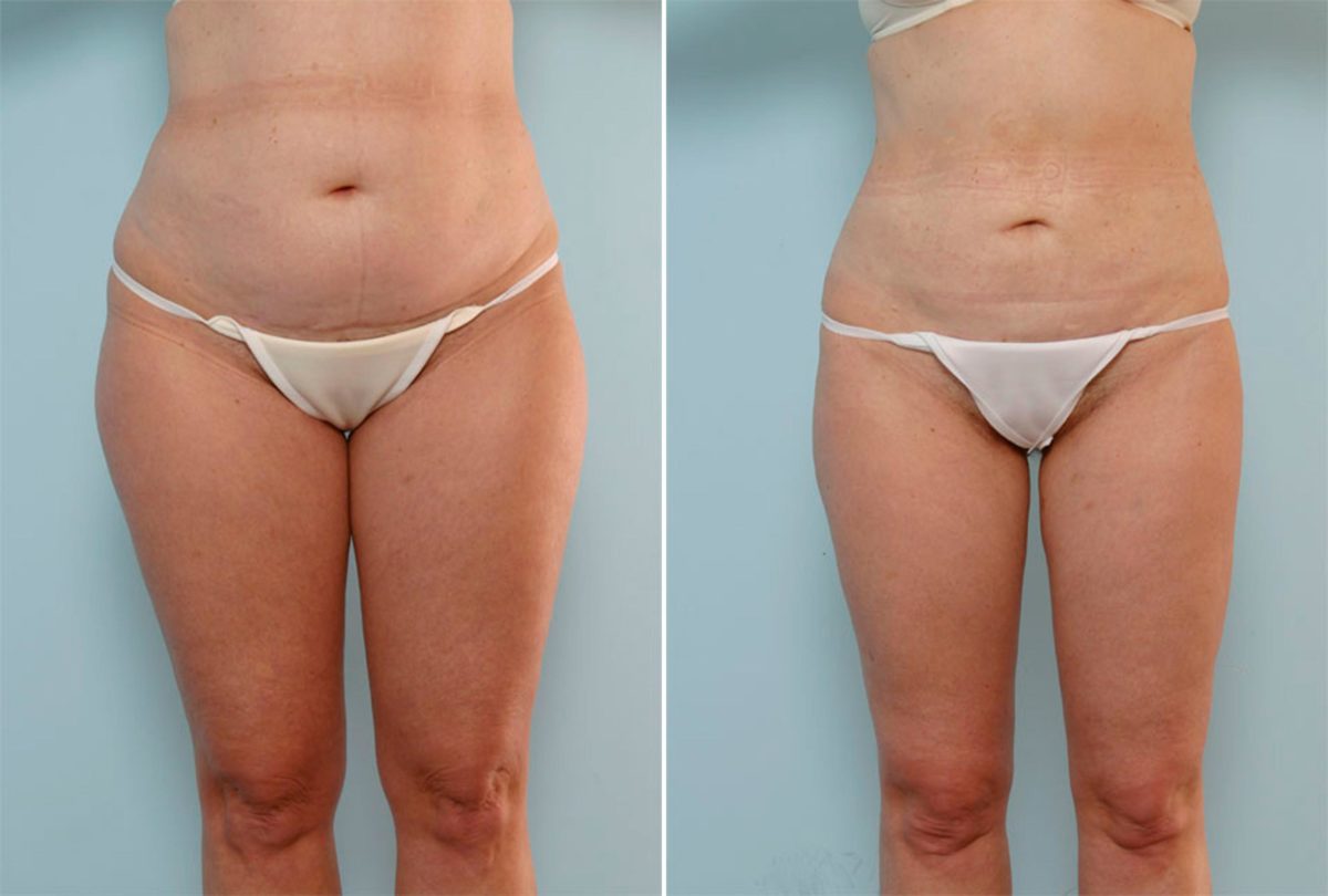 Liposuction Before and After Photos in Houston, TX, Patient 29005