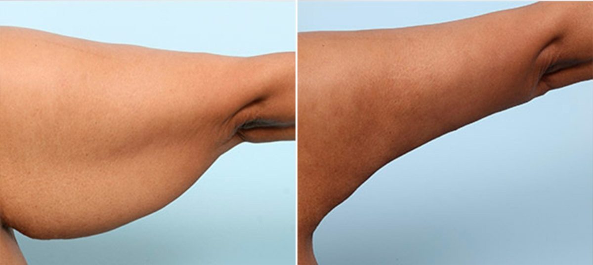 What Causes “Bat Wings?”, Before and After Photos Brachioplasty (Arm Lift) Before and After Photos in Houston, TX, Patient 27137