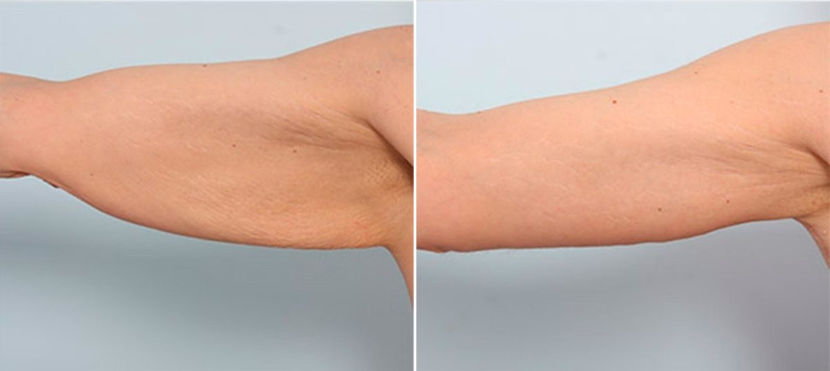 What Causes “Bat Wings?”, Before and After Photos Brachioplasty (Arm Lift) Before and After Photos in Houston, TX, Patient 27122