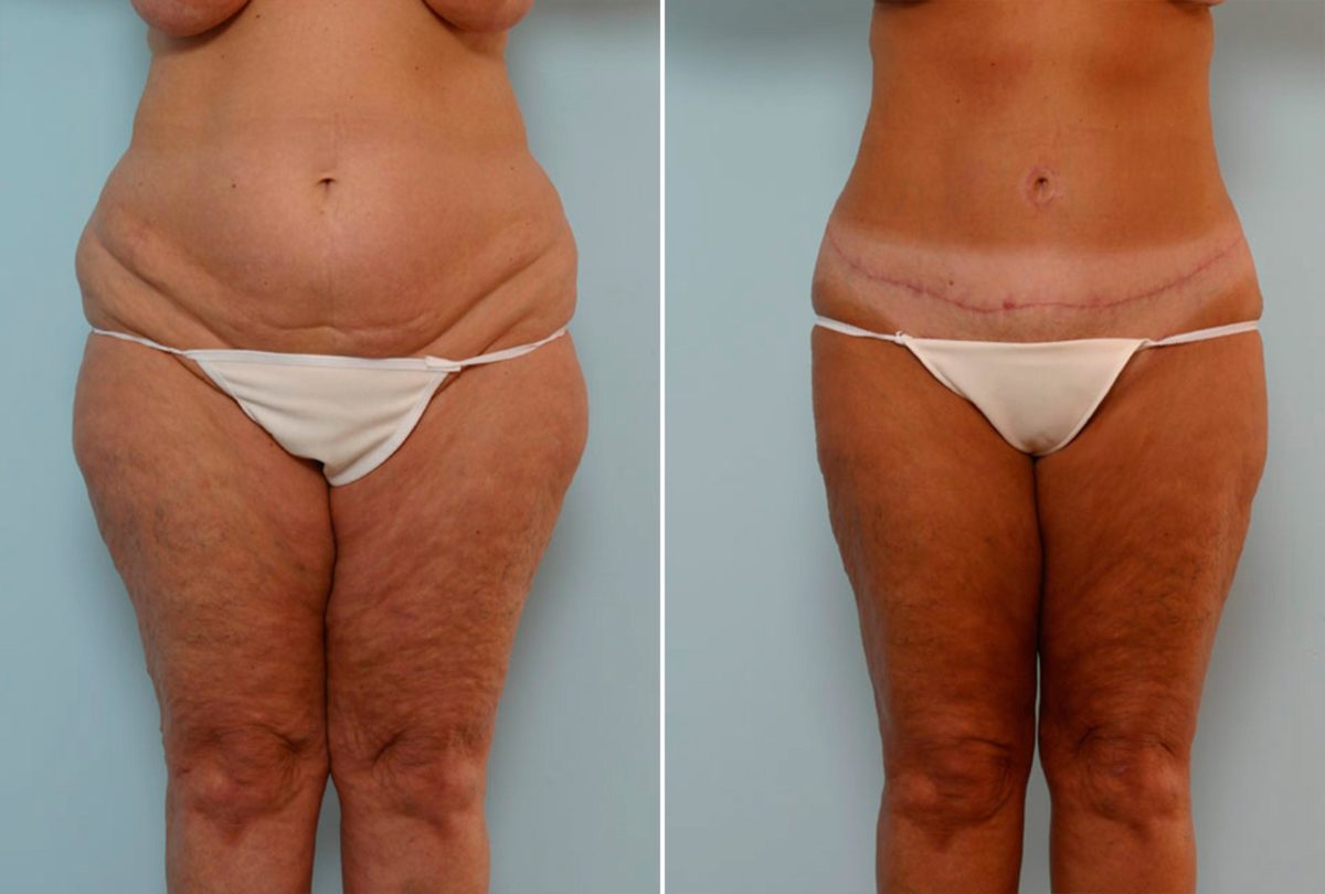 What No One Tells You About a Tummy Tuck, Before and After Photos Abdominoplasty Before and After Photos in Houston, TX, Patient 24315