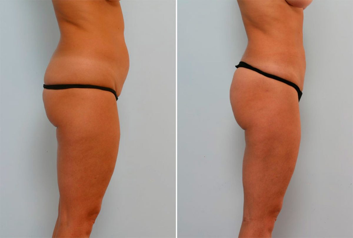 Your Complete Guide to Liposuction, Before and After Photos Liposuction Before and After Photos in Houston, TX, Patient 28943