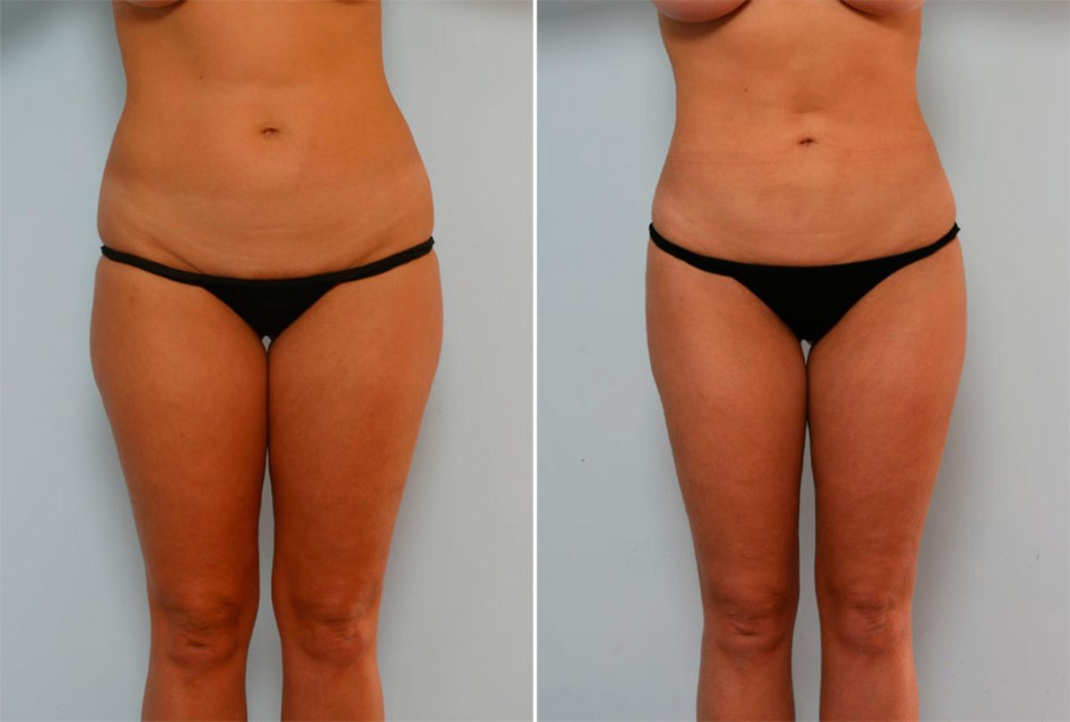 Your Complete Guide to Liposuction, Before and After Photos Liposuction Before and After Photos in Houston, TX, Patient 28943