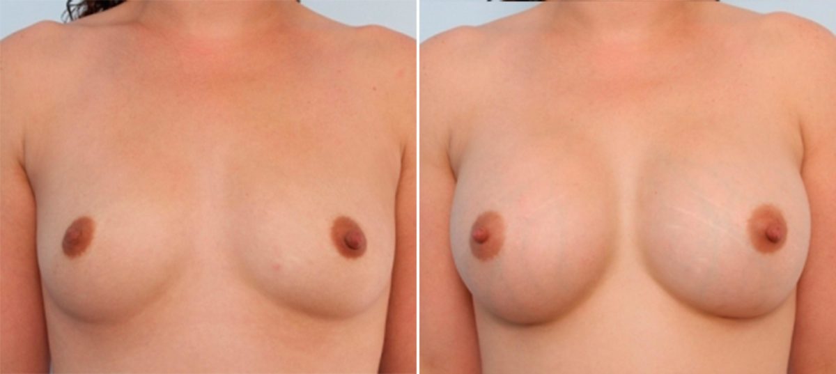 Breast Augmentation Before and After Photos in Houston, TX, Patient 24666