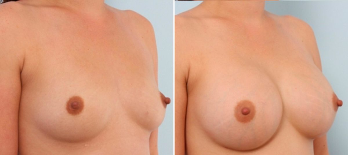 Breast Augmentation Before and After Photos in Houston, TX, Patient 24666