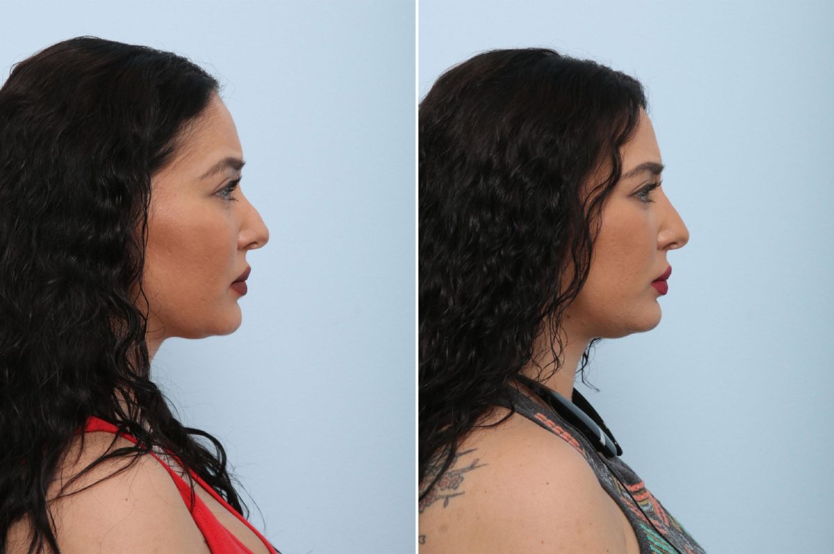 Non-Surgical Vs. Surgical Rhinoplasty: Whatâs the Difference?, Before and After Photos Non-Surgical Rhinoplasty Before and After Photos in Houston, TX, Patient 43115