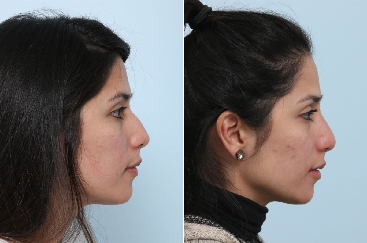 Non-Surgical Vs. Surgical Rhinoplasty: Whatâs the Difference?, Before and After Photos Non-Surgical Rhinoplasty Before and After Photos in Houston, TX, Patient 43136