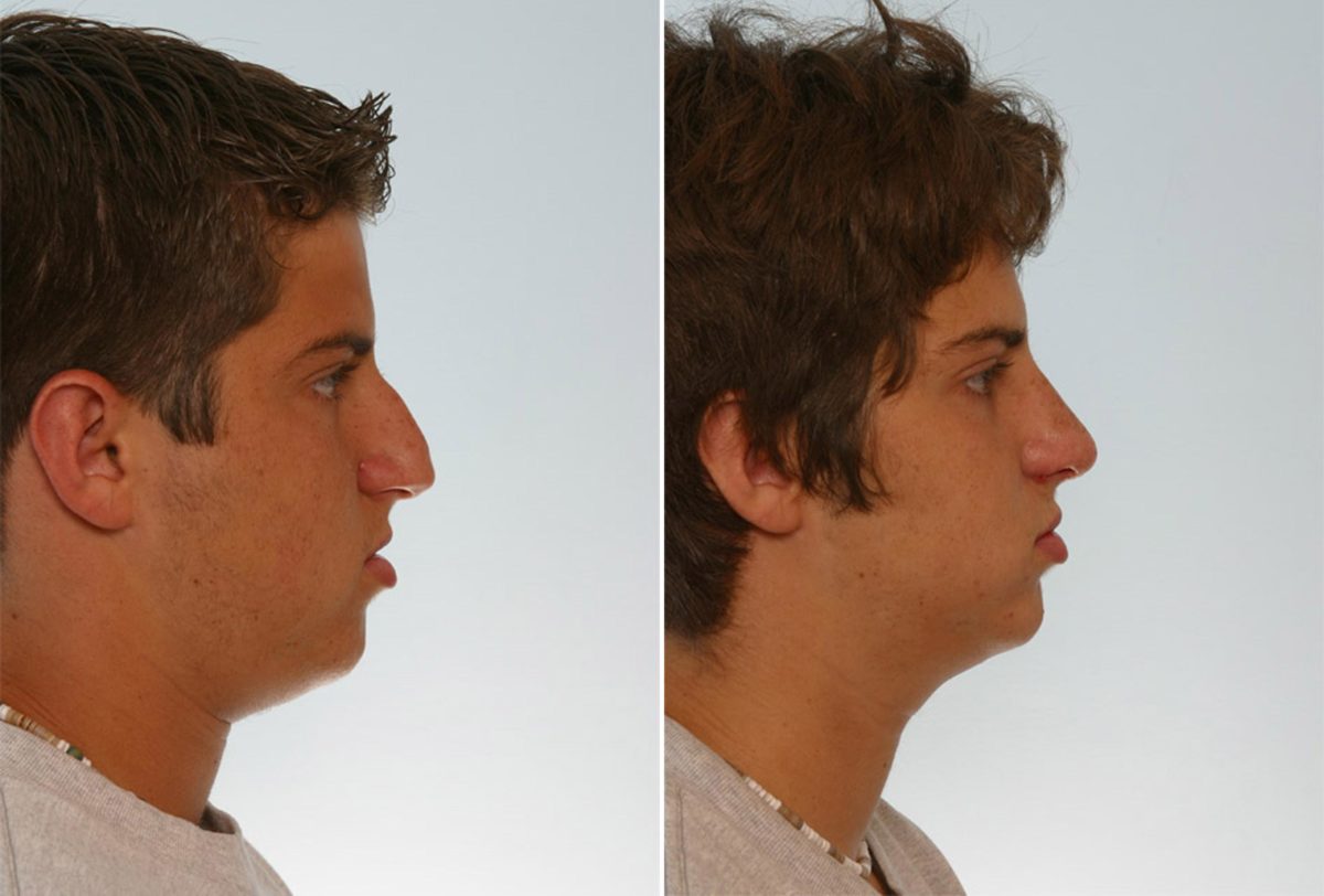 Non-Surgical Vs. Surgical Rhinoplasty: Whatâs the Difference?, Before and After Photos Rhinoplasty Before and After Photos in Houston, TX, Patient 29557