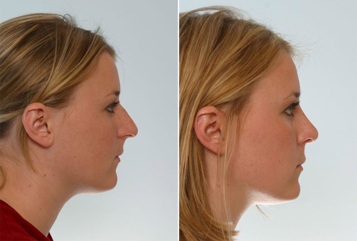 Non-Surgical Vs. Surgical Rhinoplasty: Whatâs the Difference?, Before and After Photos Rhinoplasty Before and After Photos in Houston, TX, Patient 29604