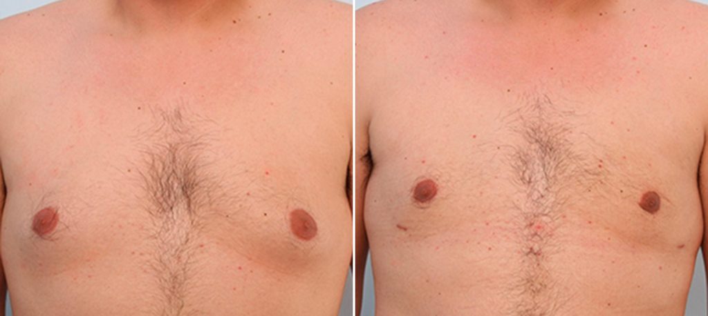 Gynecomastia before and after photos -   front view