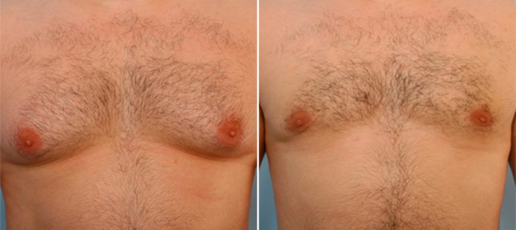 Gynecomastia before and after photos - frontal view