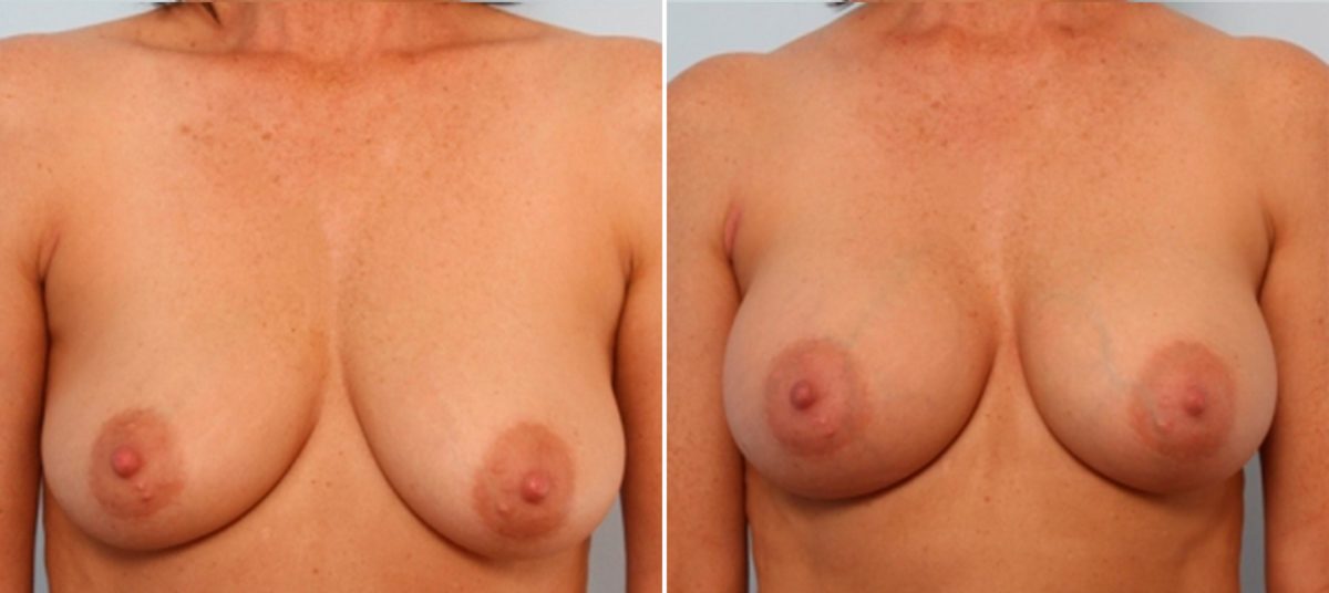 Do You Have Asymmetrical Breasts? Here’s What You Can Do, Before and After Photos Breast Augmentation Before and After Photos in Houston, TX, Patient 24831