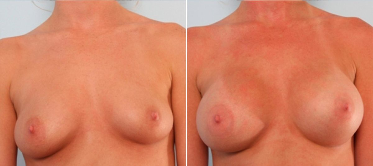 Breast Augmentation Before and After Photos in Houston, TX, Patient 24875