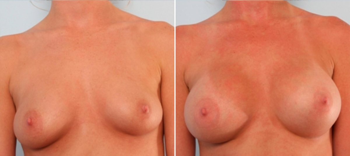 Do You Have Asymmetrical Breasts? Here’s What You Can Do, Before and After Photos Breast Augmentation Before and After Photos in Houston, TX, Patient 24875