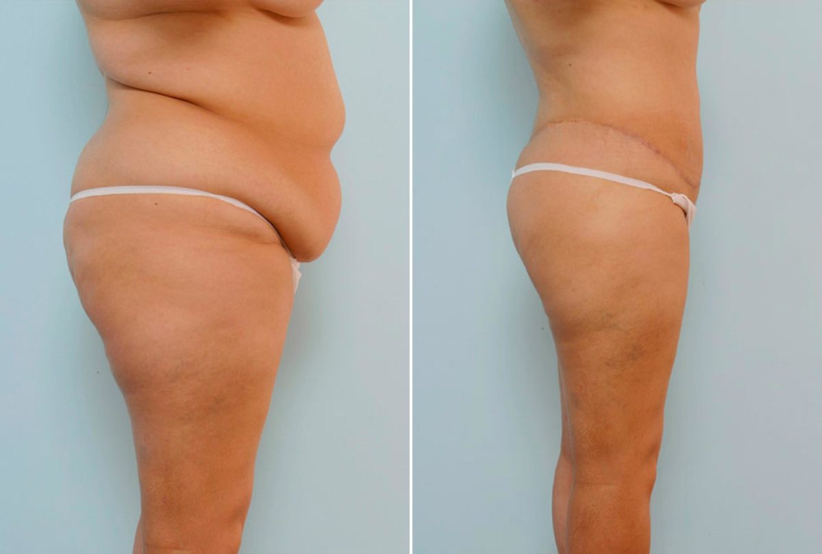 How To Choose the Right Body Procedure, Before and After Photos Body Lift Before and After Photos in Houston, TX, Patient 26806