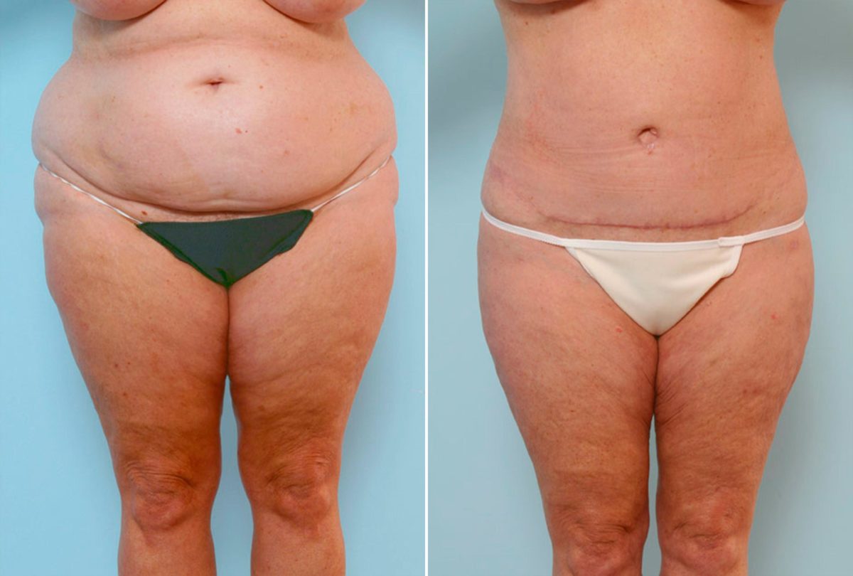 How To Choose the Right Body Procedure, Before and After Photos Body Lift Before and After Photos in Houston, TX, Patient 26815