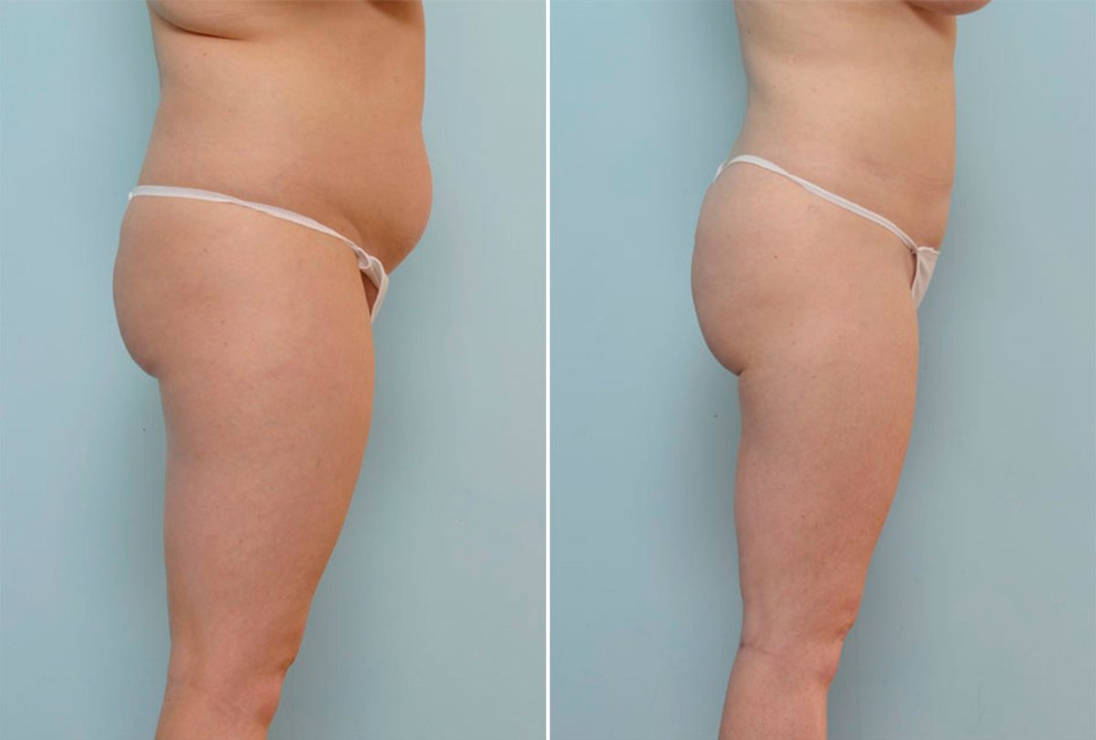 How To Choose the Right Body Procedure, Before and After Photos Liposuction Before and After Photos in Houston, TX, Patient 28921
