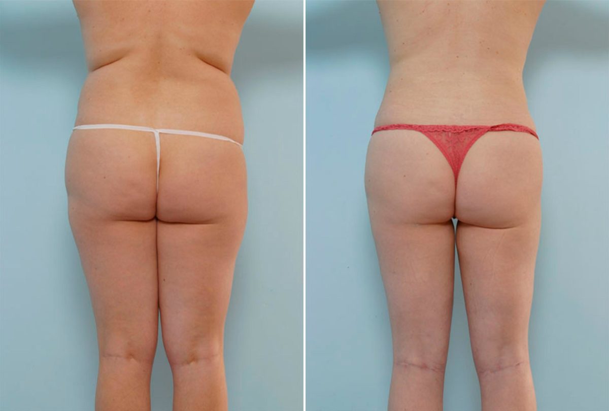 Liposuction Before and After Photos in Houston, TX, Patient 28921
