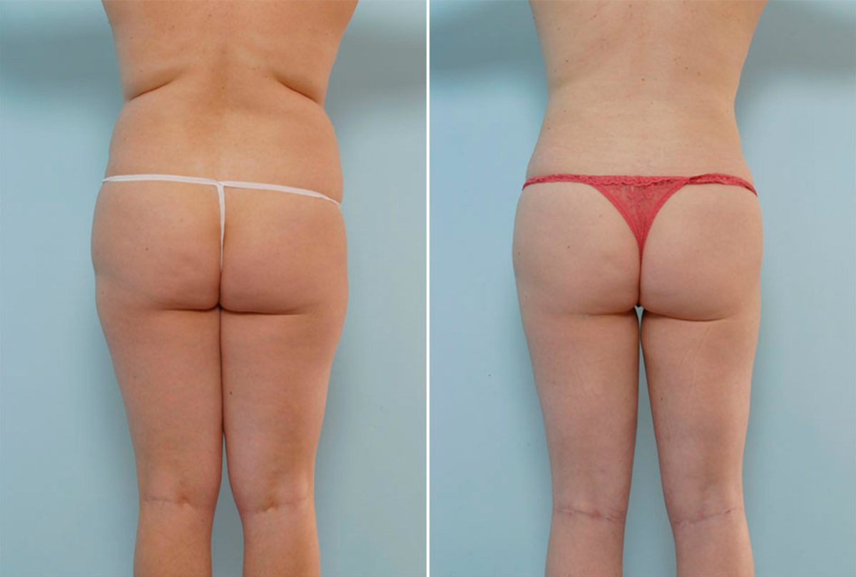 How To Choose the Right Body Procedure, Before and After Photos Liposuction Before and After Photos in Houston, TX, Patient 28921