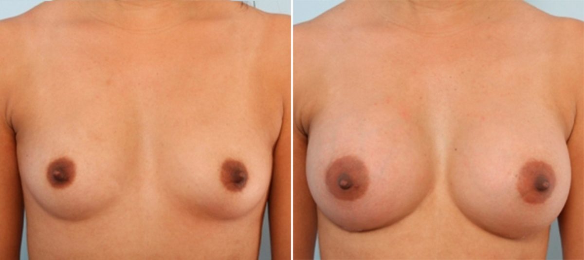 Breast Implants vs. Fat Transfer: Which is Better for Breast Augmentation?, Before and After Photos Breast Augmentation Before and After Photos in Houston, TX, Patient 24677