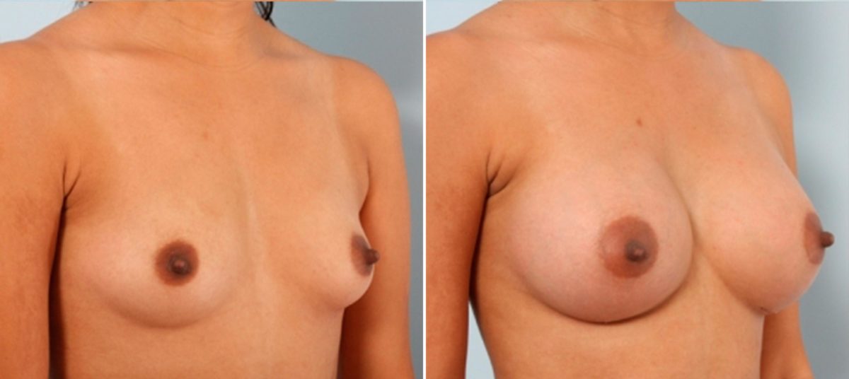 Breast Implants vs. Fat Transfer: Which is Better for Breast Augmentation?, Before and After Photos Breast Augmentation Before and After Photos in Houston, TX, Patient 24677