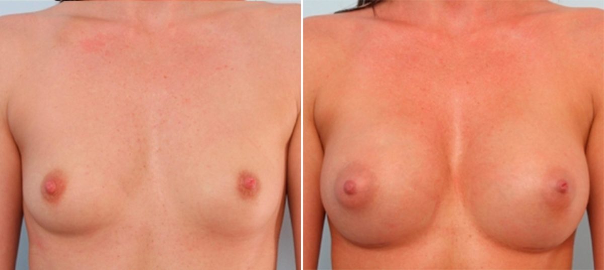 Breast Implants vs. Fat Transfer: Which is Better for Breast Augmentation?, Before and After Photos Breast Augmentation Before and After Photos in Houston, TX, Patient 24699