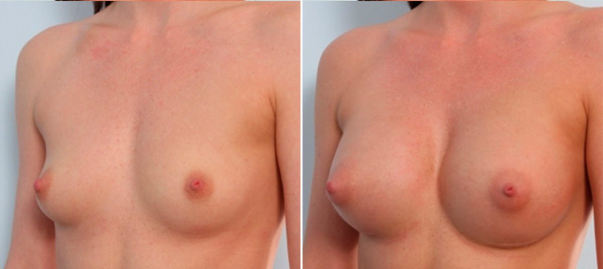 Breast Implants vs. Fat Transfer: Which is Better for Breast Augmentation?, Before and After Photos Breast Augmentation Before and After Photos in Houston, TX, Patient 24699