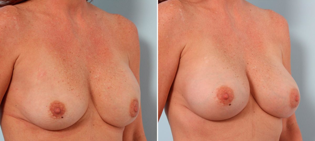 Breast Implant Exchange Before and After Photos in Houston, TX, Patient 27380