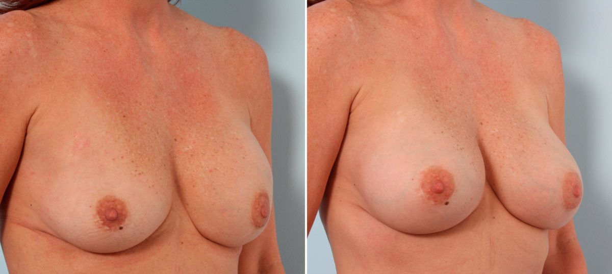Benefits of Breast Implant Exchange, Before and After Photos Breast Implant Exchange Before and After Photos in Houston, TX, Patient 27380
