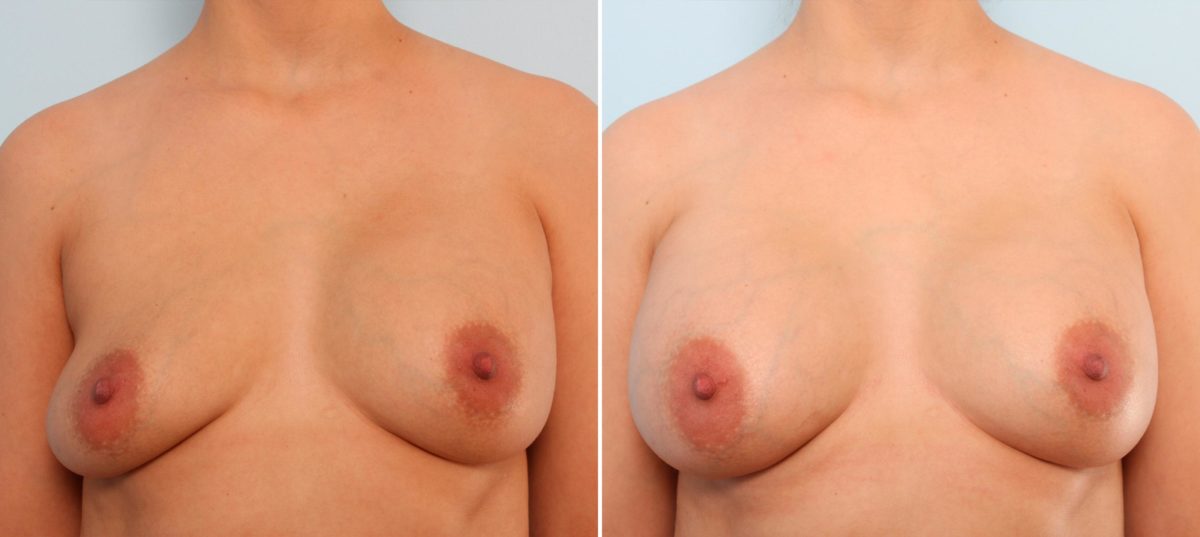 Breast Implant Exchange Before and After Photos in Houston, TX, Patient 27401