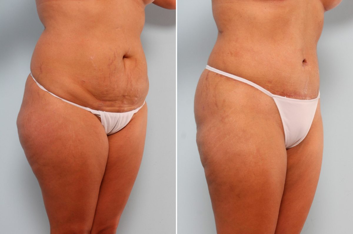 How to Get Through the Recovery After a Mommy Makeover, Before and After Photos Mommy Makeover Before and After Photos in Houston, TX, Patient 29288