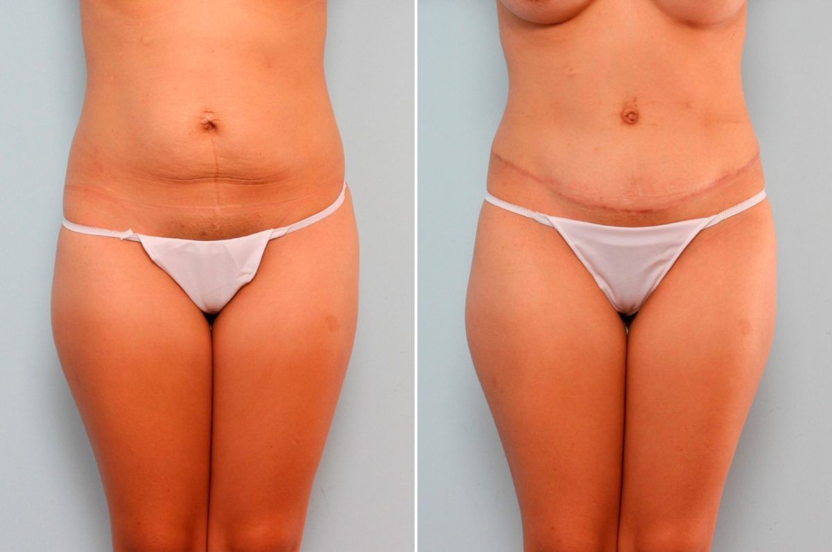 How to Get Through the Recovery After a Mommy Makeover, Before and After Photos Mommy Makeover Before and After Photos in Houston, TX, Patient 29296