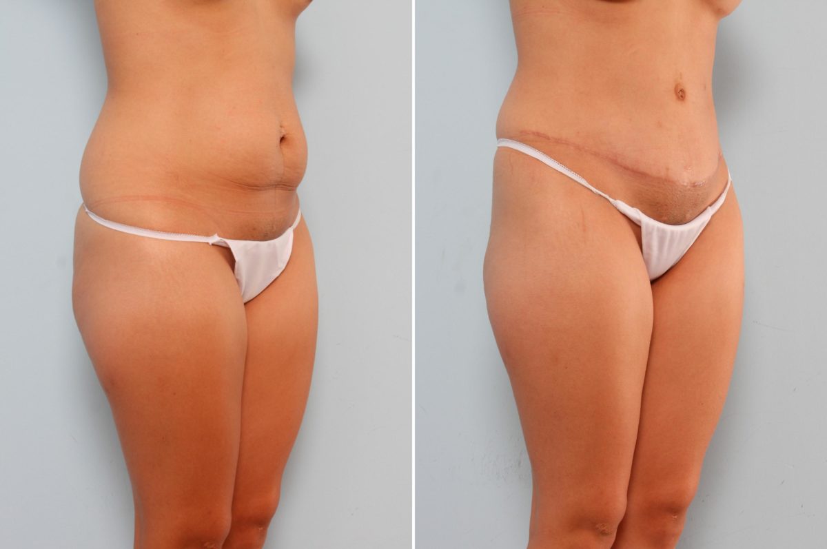 How to Get Through the Recovery After a Mommy Makeover, Before and After Photos Mommy Makeover Before and After Photos in Houston, TX, Patient 29296