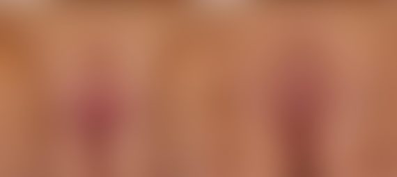 Answers to the Labiaplasty Questions You Were Too Shy to Ask, Before and After Photos Labiaplasty Before and After Photos in Houston, TX, Patient 28736