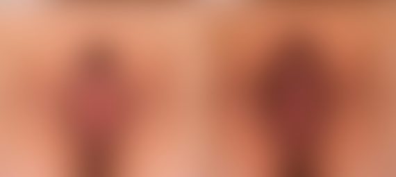 Answers to the Labiaplasty Questions You Were Too Shy to Ask, Before and After Photos Labiaplasty Before and After Photos in Houston, TX, Patient 34758
