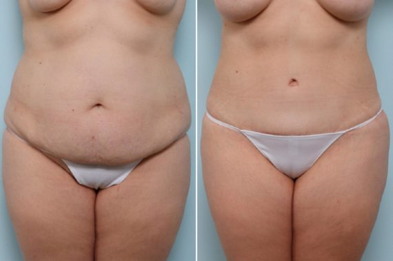 Do You Need To Be a Mom to Undergo a Mommy Makeover?, Before and After Photos Mommy Makeover Before and After Photos in Houston, TX, Patient 57491